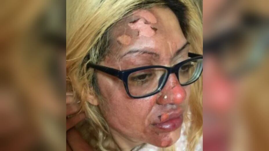 Shafia Bashir terminó con fuertes quemadas, por querer hacer un truco de TikTok.