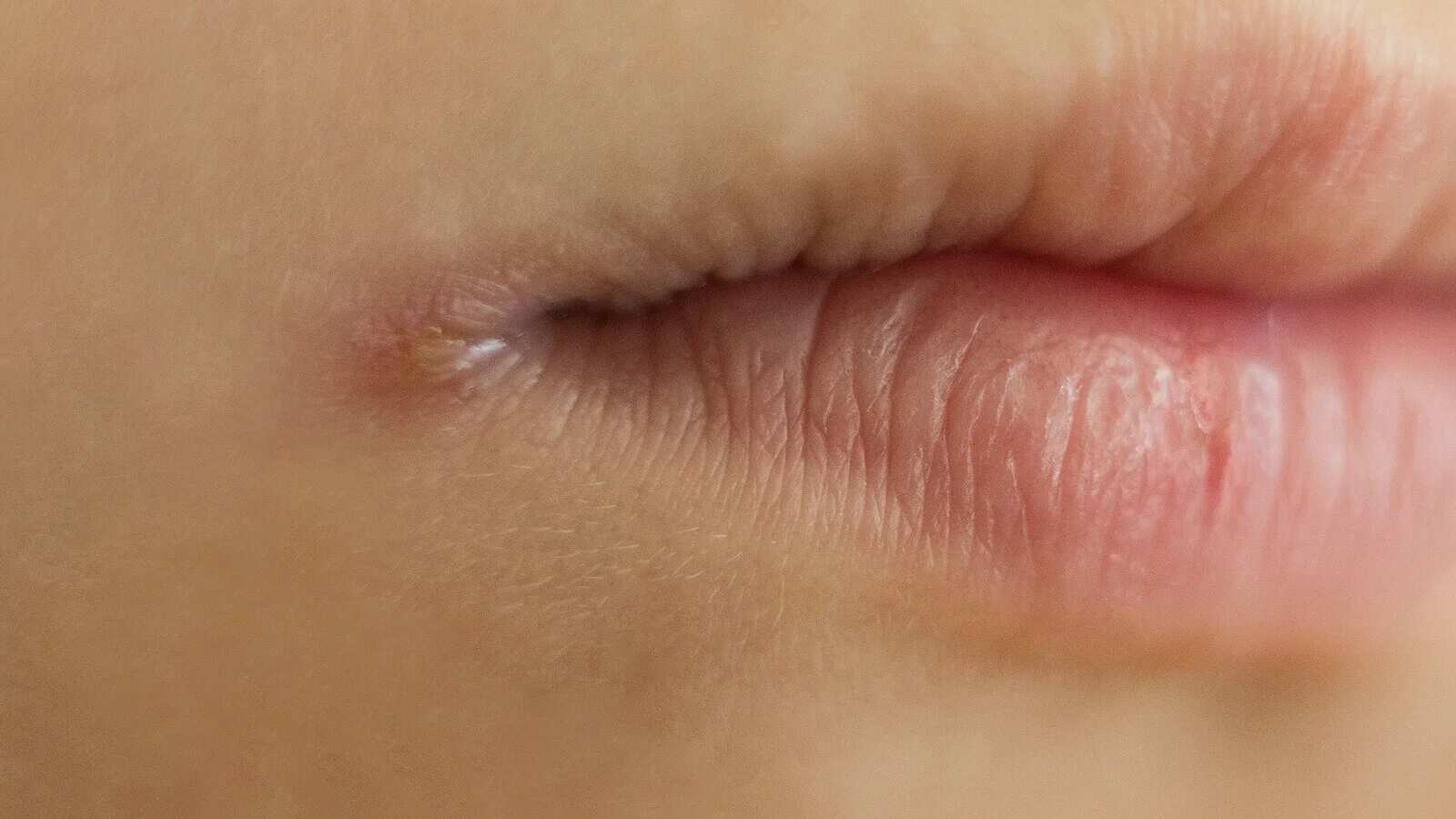 El limón ayuda erradicar la boquera.