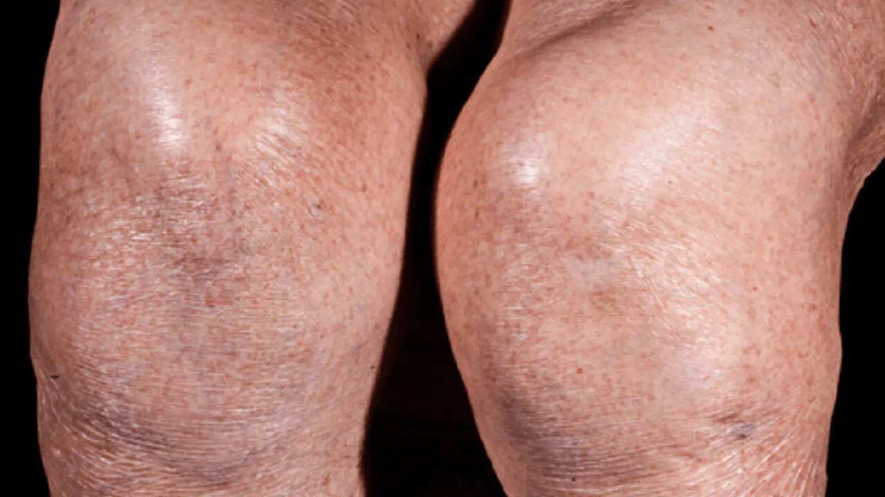 Para las personas con rodillas reconstruidas son ideales los ejercicios en el agua.