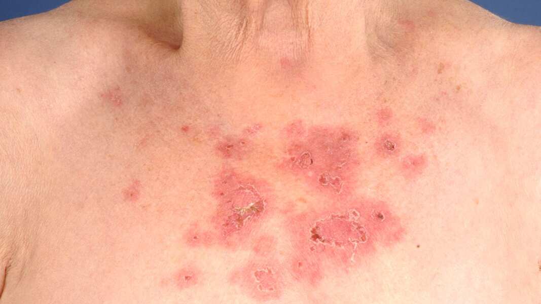 El lupus afecta más a las mujeres.