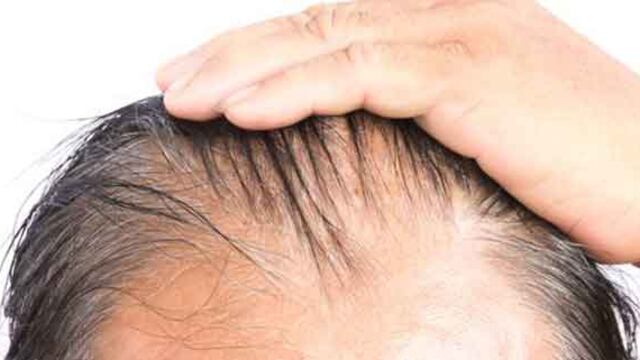 El aceite de romero previene la caída del cabello en los hombres