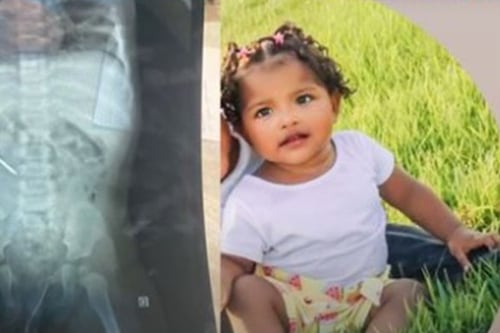 Una niña en Brasil se tragó un clavo en el festejo de su primer cumpleaños