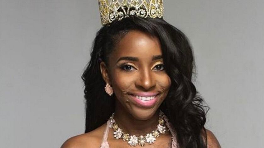 mujer quemada embarazo