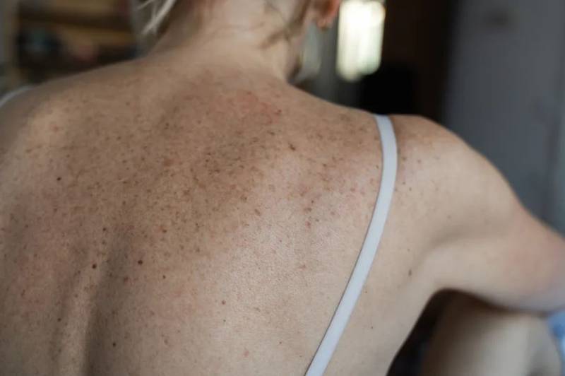 Hombres y mujeres ven aparecer en su piel estas manchas que advierten del paso del tiempo.| Foto: Getty Creative.