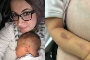 Mamá es acusada de maltrato infantil después de llevar a su bebé con moretones al hospital